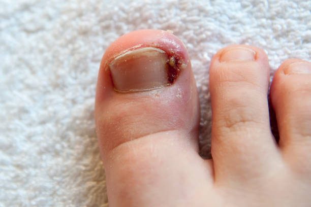 DIY Solutions vs. Doctor Visit: When Can You Treat an Ingrown Toenail at Home - BlogBursts 100% Free Guest Posting Website